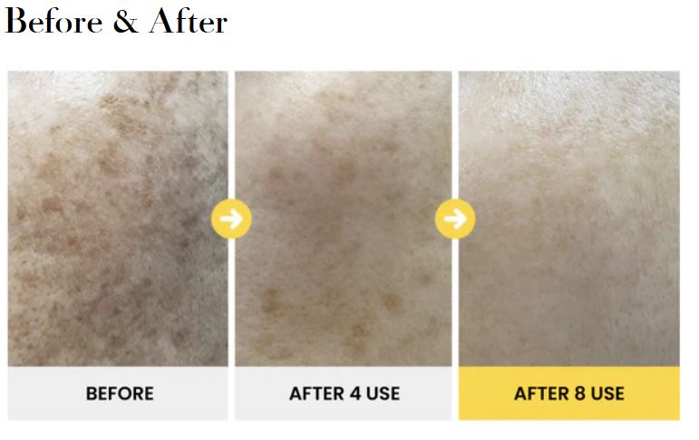 Brightening Micro-channeling Home Facial Kit (Value at $285)